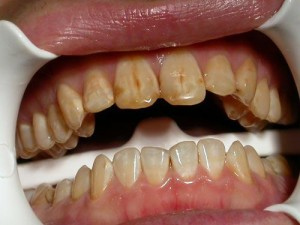 Почему зубы темнеют? Причины и методы лечения